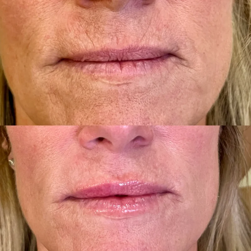 Lip fillers-Gallery-A-in-Augusta-GA