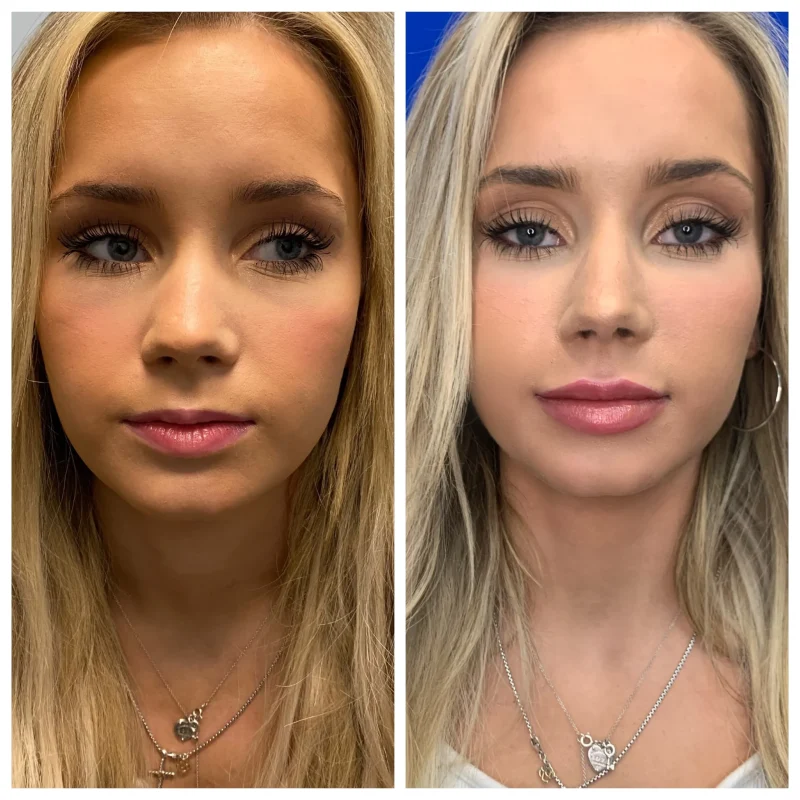 Lip fillers-Gallery-B-in-Augusta-GA