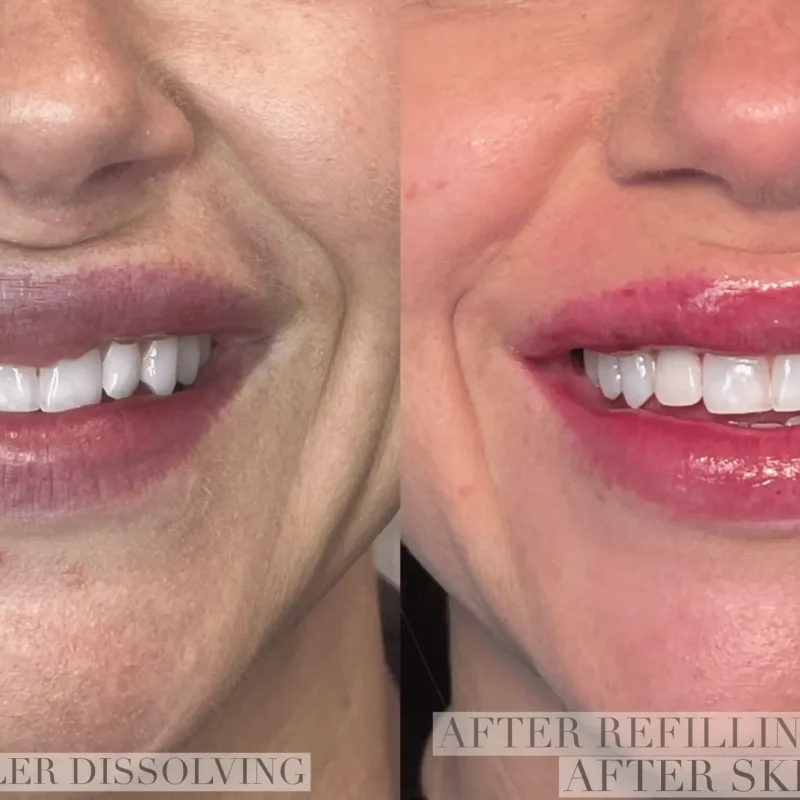 Lip fillers-Gallery-C-in-Augusta-GA_11zon