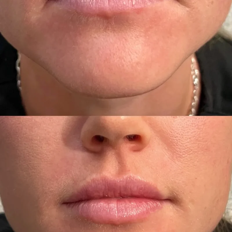 Lip fillers-Gallery-D-in-Augusta-GA