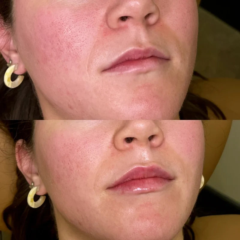 Lip fillers-Gallery-F-in-Augusta-GA