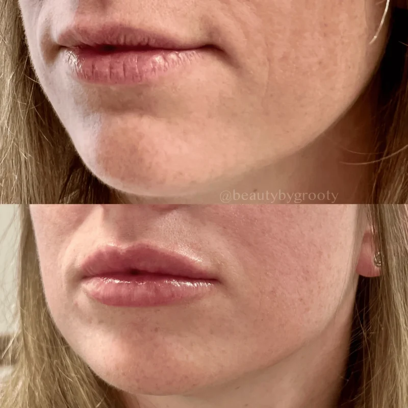 Lip fillers-Gallery-I-in-Augusta-GA_11zon