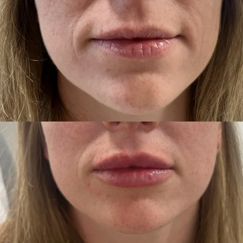 Lip fillers-Gallery-J-in-Augusta-GA