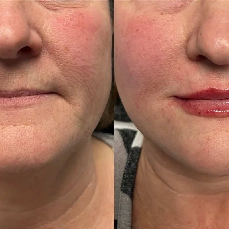 Lip fillers-Gallery-in-Augusta-GA