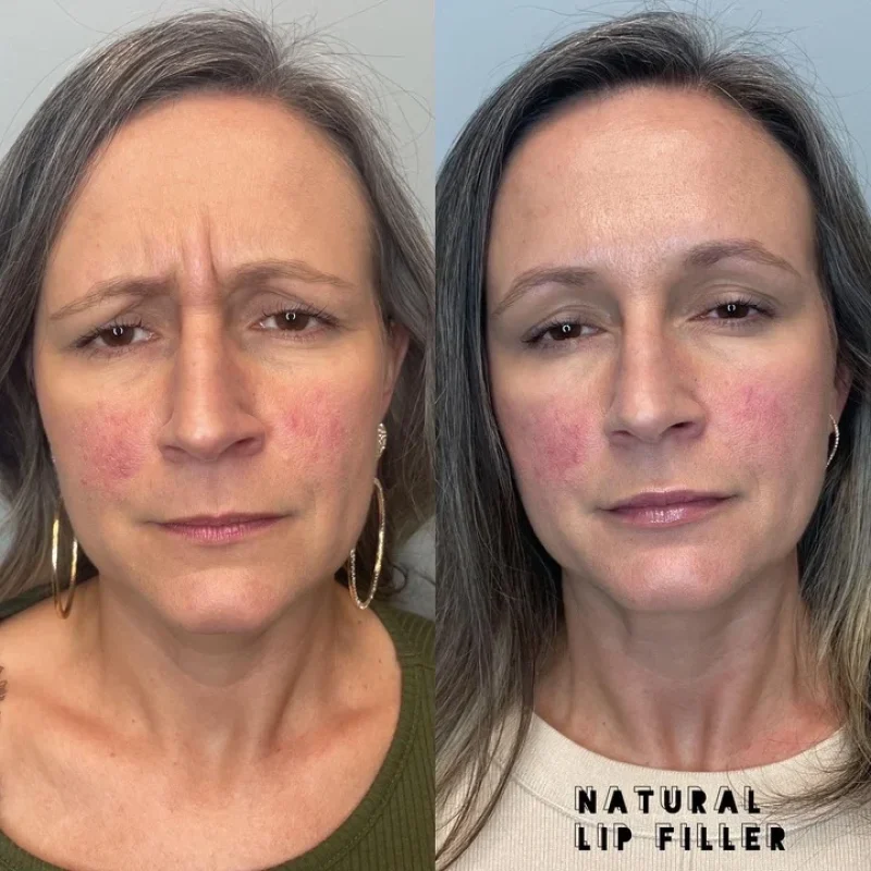 before-after-botox-a-botox-and-dysport-in-evans-ga