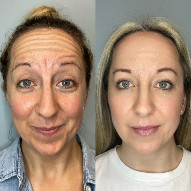 before-after-botox-b-botox-and-dysport-in-evans-ga