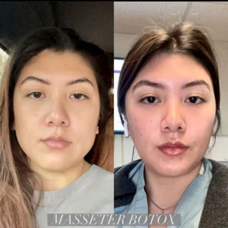 before-after-botox-c-botox-and-dysport-in-evans-ga