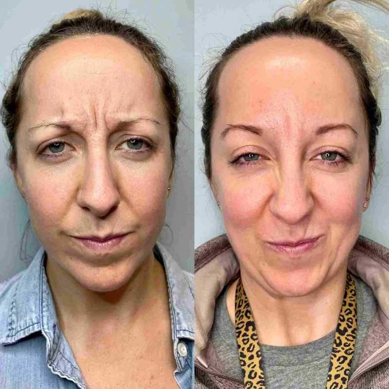 before-after-botox-d-botox-and-dysport-in-evans-ga