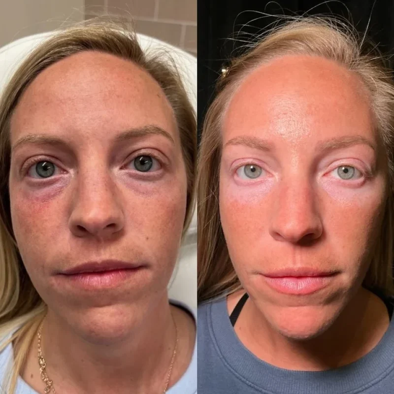 before-after-c-under eye-juvederm-dermal-filler-collection-in-evans-ga