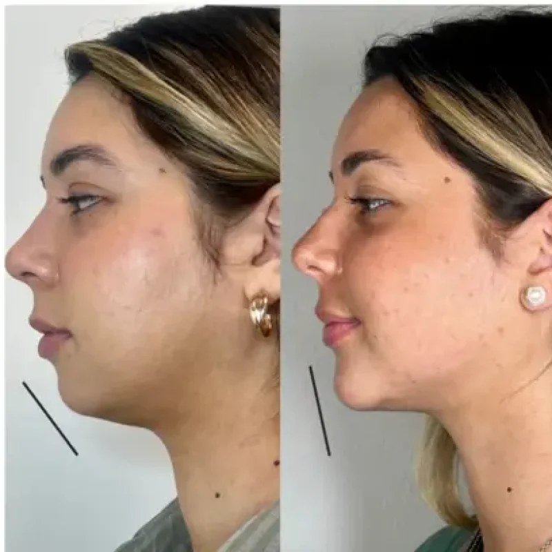 before-after-chin-a-juvederm-dermal-filler-collection-in-evans-ga-1