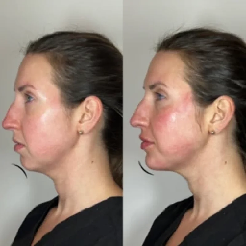 before-after-chin-b-juvederm-dermal-filler-collection-in-evans-ga