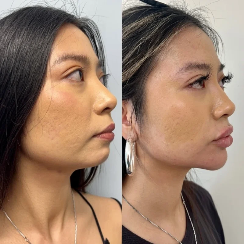 before-after-chin-c-juvederm-dermal-filler-collection-in-evans-ga