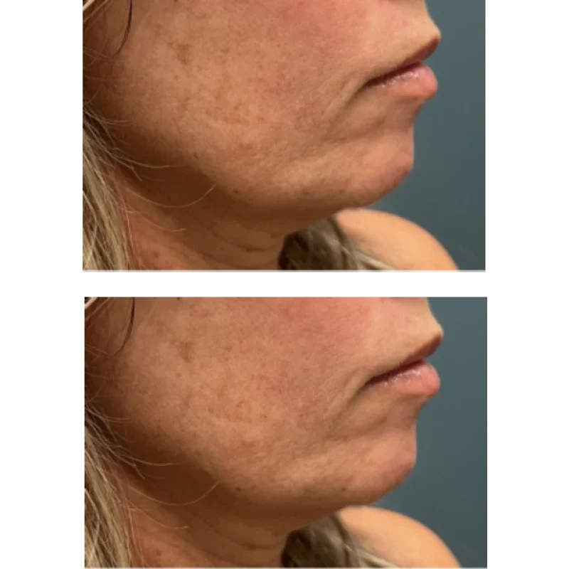 before-after-chin-d-juvederm-dermal-filler-collection-in-evans-ga-a-edited