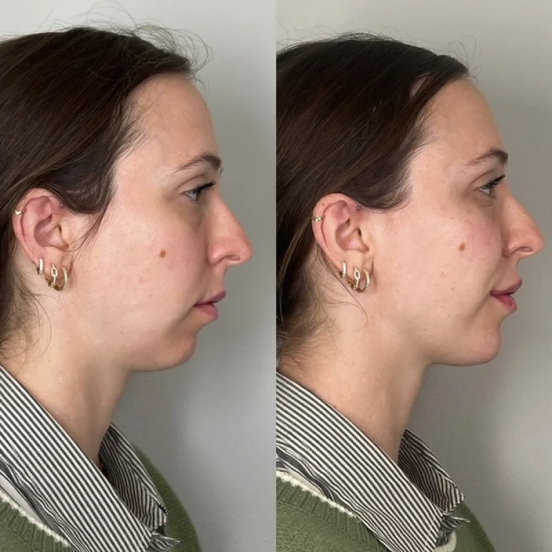 before-after-chin-e-juvederm-dermal-filler-collection-in-evans-ga