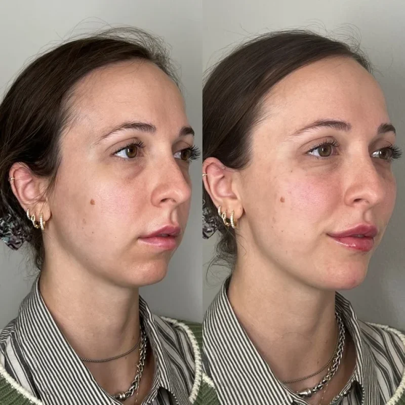 before-after-chin-s-juvederm-dermal-filler-collection-in-evans-ga