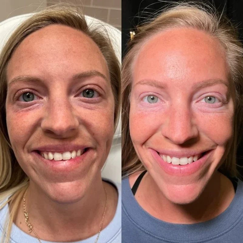 before-after-d-under eye-juvederm-dermal-filler-collection-in-evans-ga