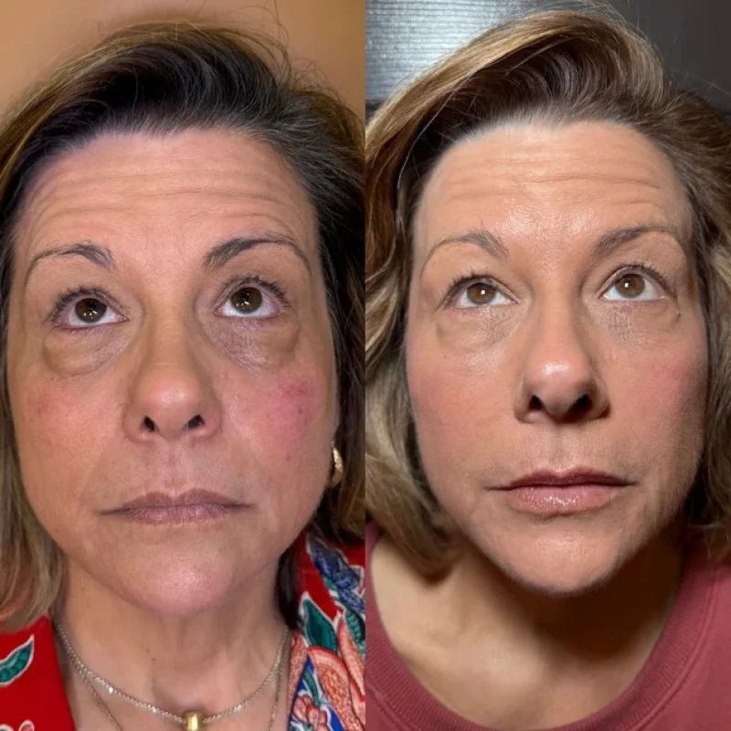 before-after-e-under eye-juvederm-dermal-filler-collection-in-evans-ga