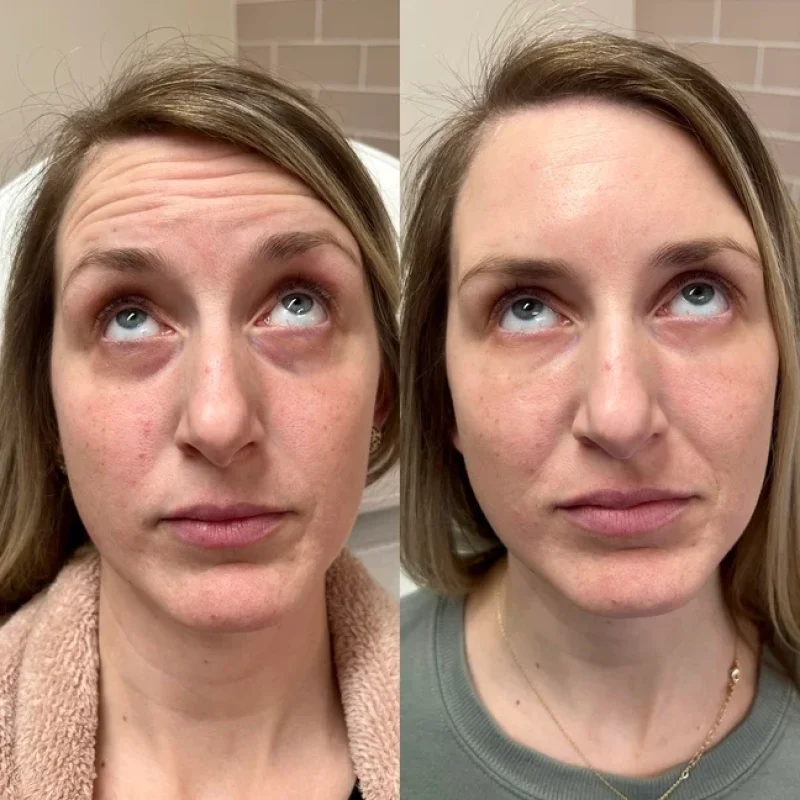 before-after-f-under eye-juvederm-dermal-filler-collection-in-evans-ga