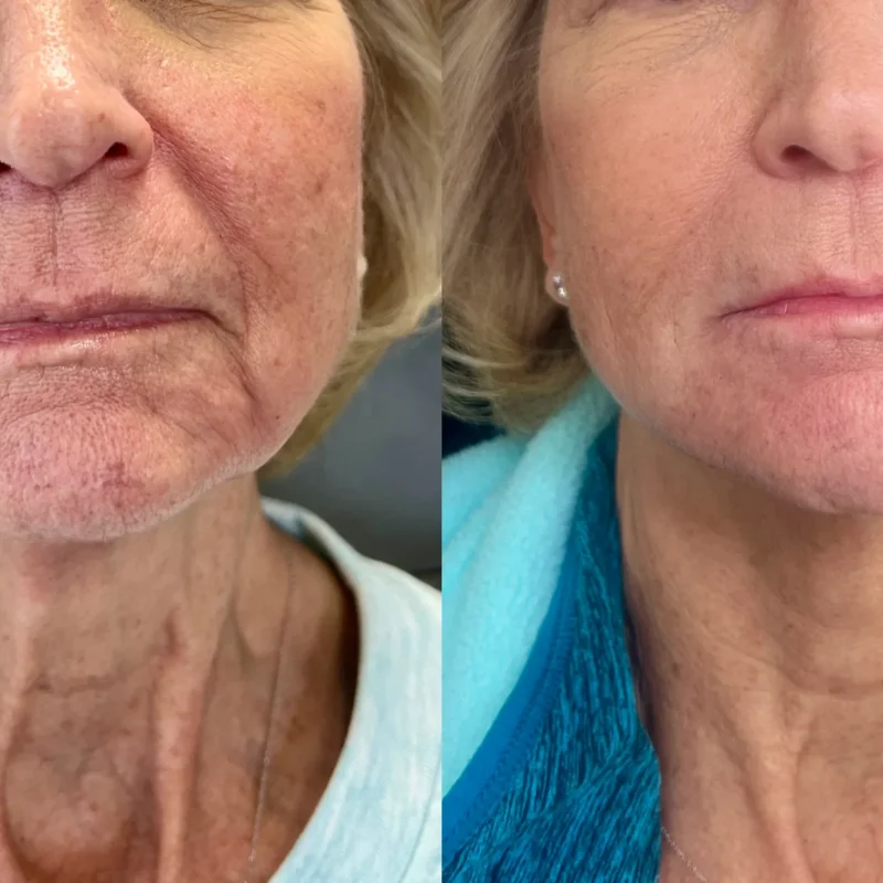 before-after-facial-balancing-b-juvederm-dermal-filler-collection-in-evans-ga-aa