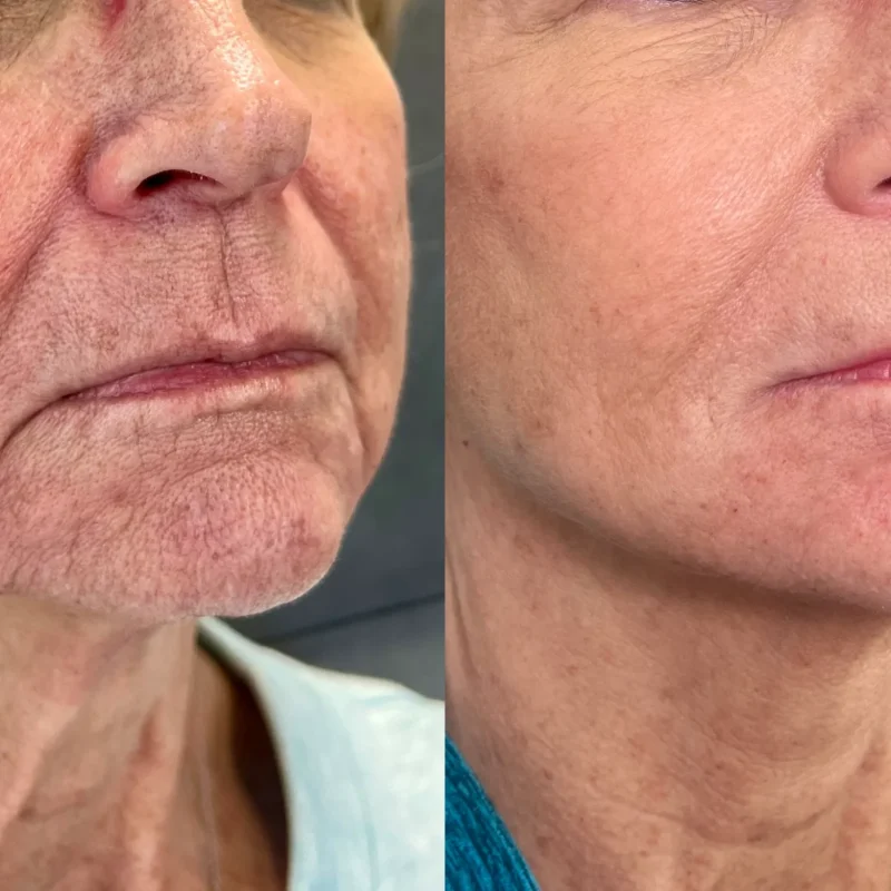 before-after-facial-balancing-b-juvederm-dermal-filler-collection-in-evans-ga-ab