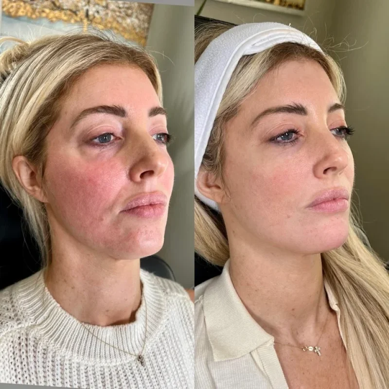 before-after-facial-balancing-c-juvederm-dermal-filler-collection-in-evans-ga