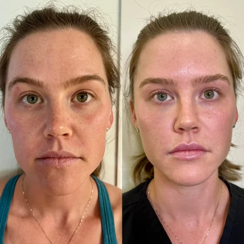 before-after-facial-balancing-d-juvederm-dermal-filler-collection-in-evans-ga