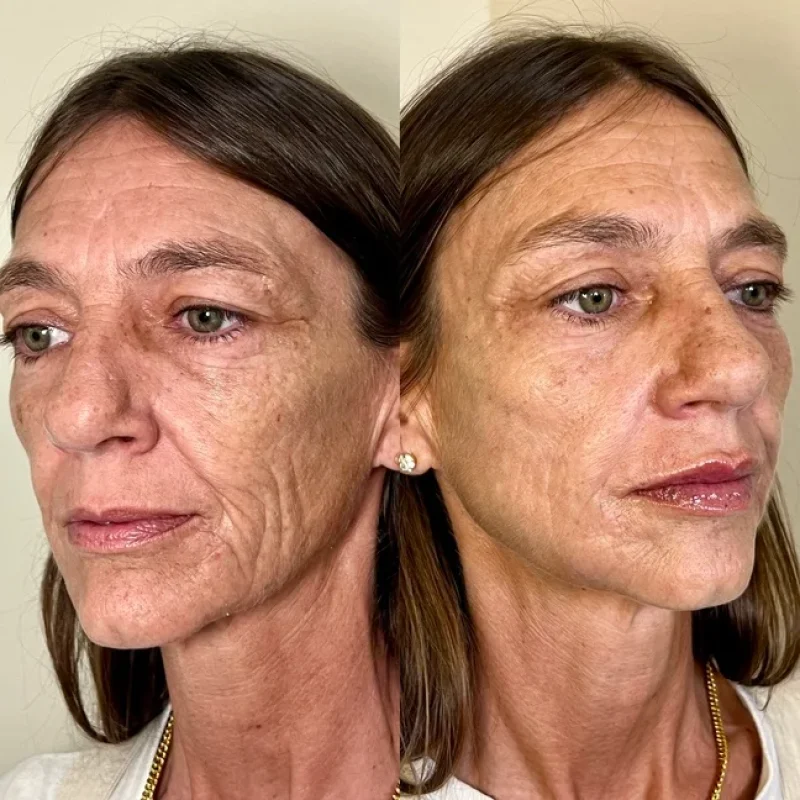 before-after-facial-balancing-e-juvederm-dermal-filler-collection-in-evans-ga