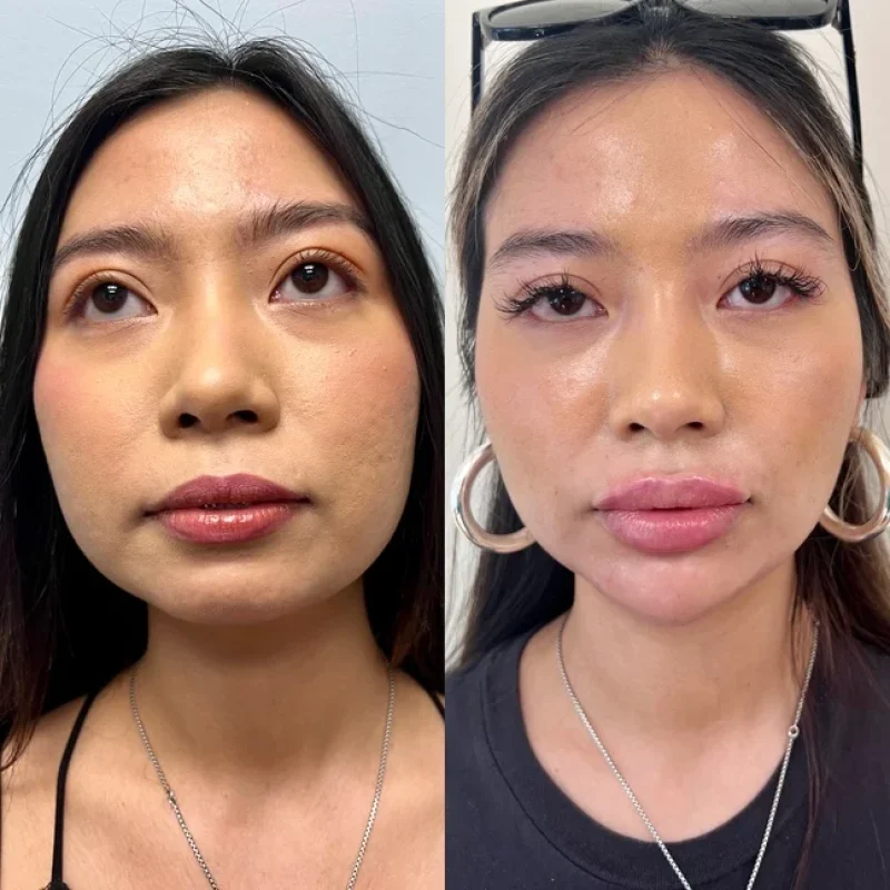 before-after-facial-balancing-f-juvederm-dermal-filler-collection-in-evans-ga