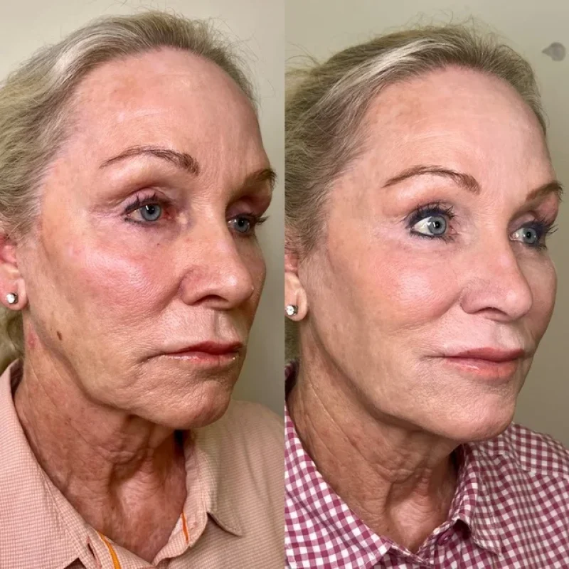 before-after-facial-balancing-g-juvederm-dermal-filler-collection-in-evans-ga