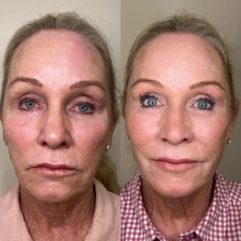 before-after-facial-balancing-h-juvederm-dermal-filler-collection-in-evans-ga