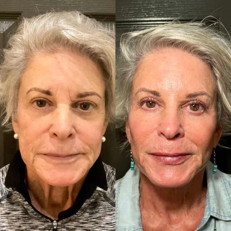 before-after-facial-balancing-i-juvederm-dermal-filler-collection-in-evans-ga