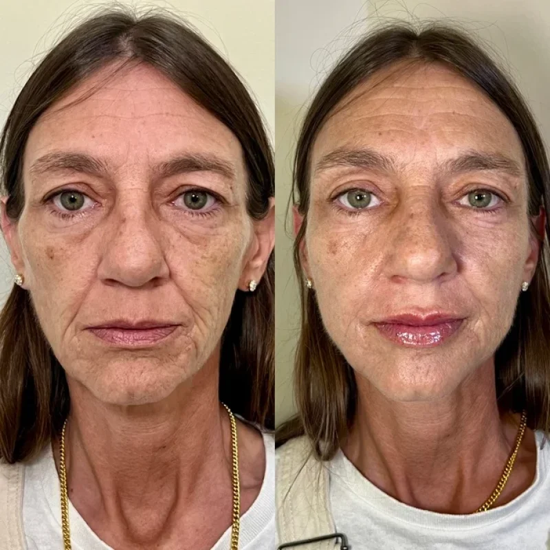 before-after-facial-balancing-j-juvederm-dermal-filler-collection-in-evans-ga