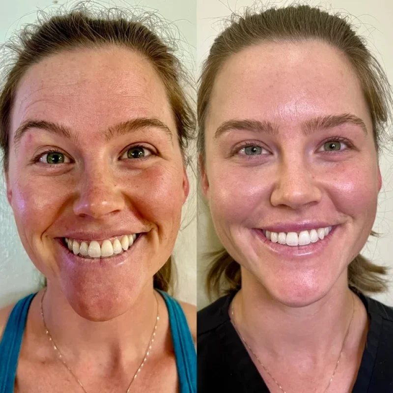 before-after-facial-balancing-k-juvederm-dermal-filler-collection-in-evans-ga