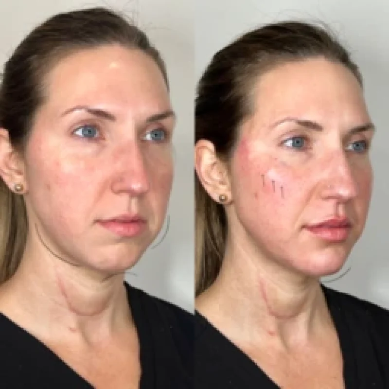 before-after-facial-balancing-l-juvederm-dermal-filler-collection-in-evans-ga