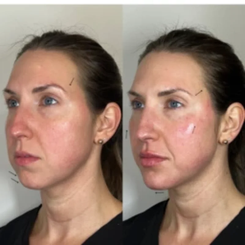 before-after-facial-balancing-o-juvederm-dermal-filler-collection-in-evans-ga