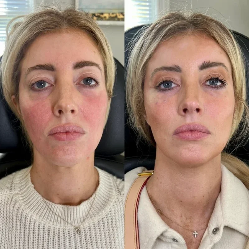 before-after-facial-balancing-p-juvederm-dermal-filler-collection-in-evans-ga