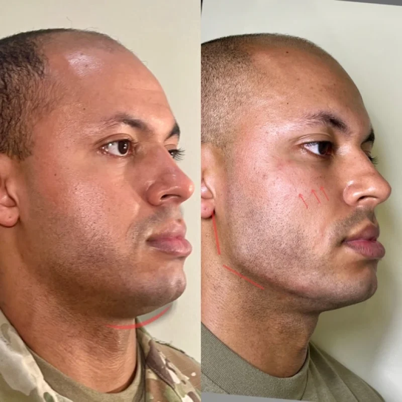 before-after-jawline-a-juvederm-dermal-filler-collection-in-evans-ga