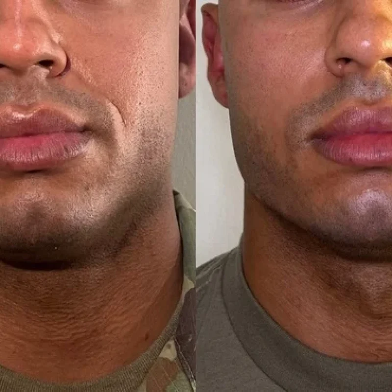 before-after-jawline-b-juvederm-dermal-filler-collection-in-evans-ga