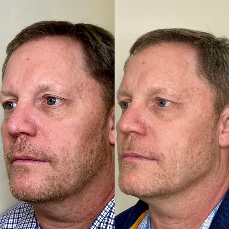 before-after-jawline-c-juvederm-dermal-filler-collection-in-evans-ga