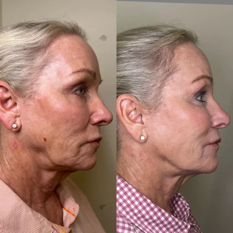 before-after-jawline-d-juvederm-dermal-filler-collection-in-evans-ga