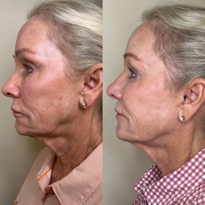 before-after-jawline-e-juvederm-dermal-filler-collection-in-evans-ga