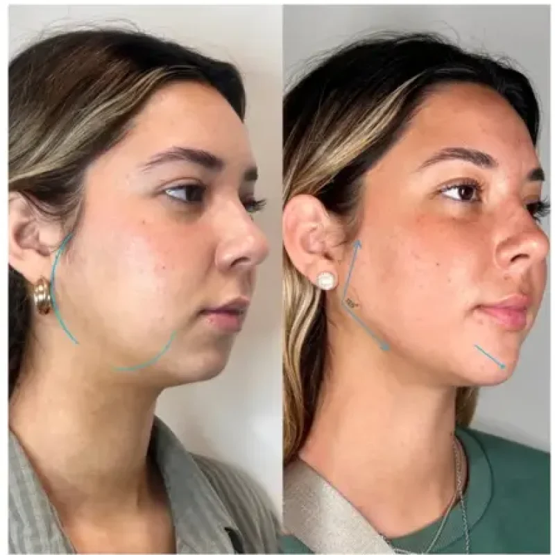 before-after-jawline-f-juvederm-dermal-filler-collection-in-evans-ga-1