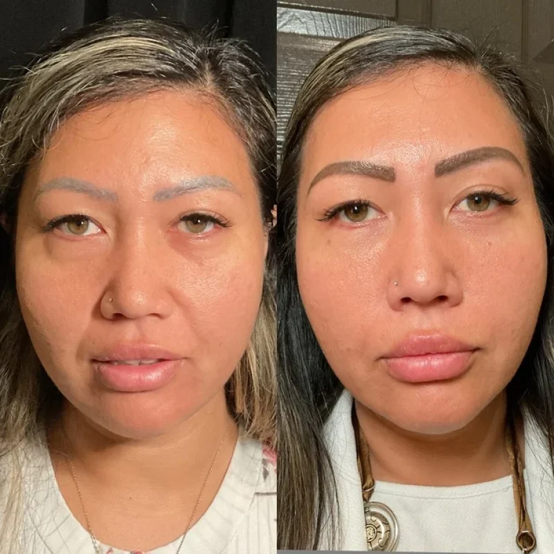 before-after-k-under eye-juvederm-dermal-filler-collection-in-evans-ga