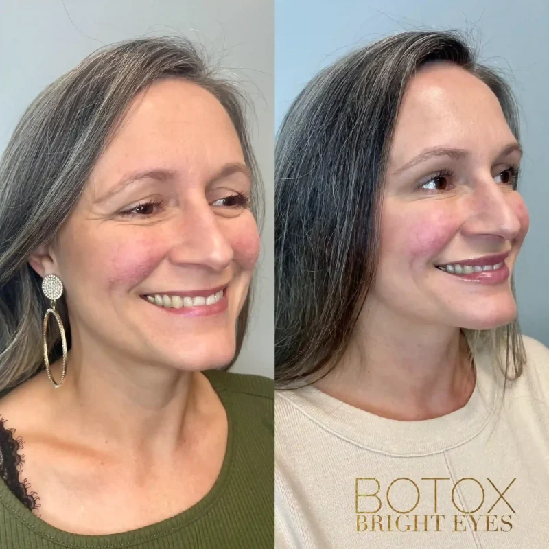 before-after-six-botox-and-dysport-in-evans-ga