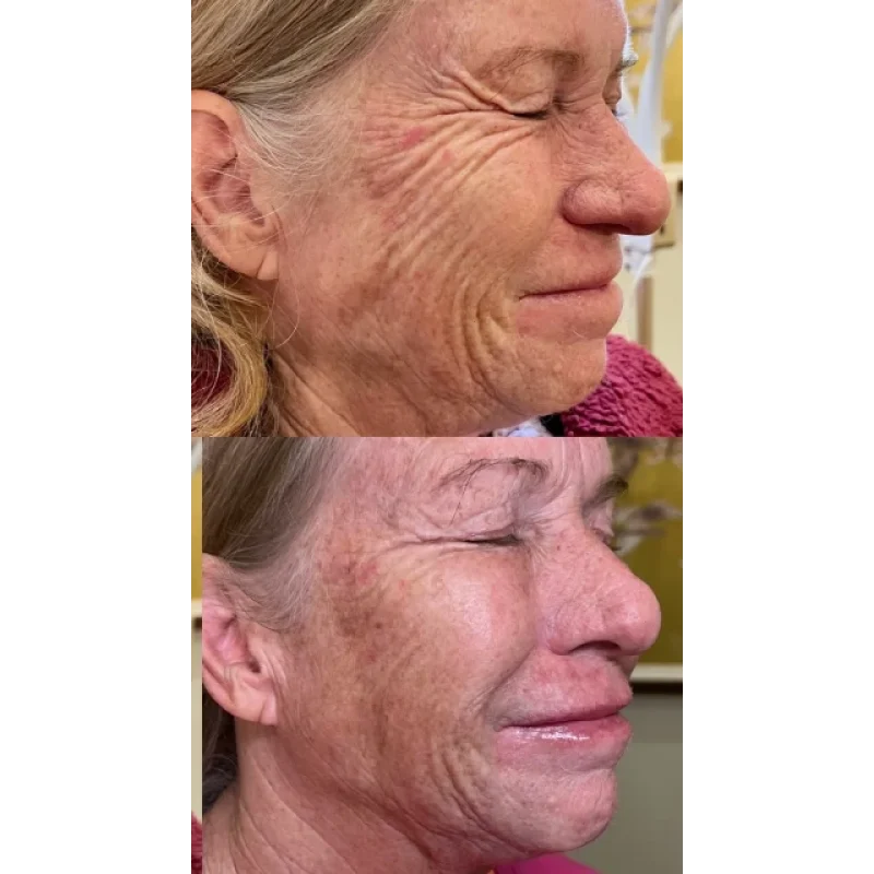 before-after-skinvive-a-juvederm-dermal-filler-collection-in-evans-ga-a