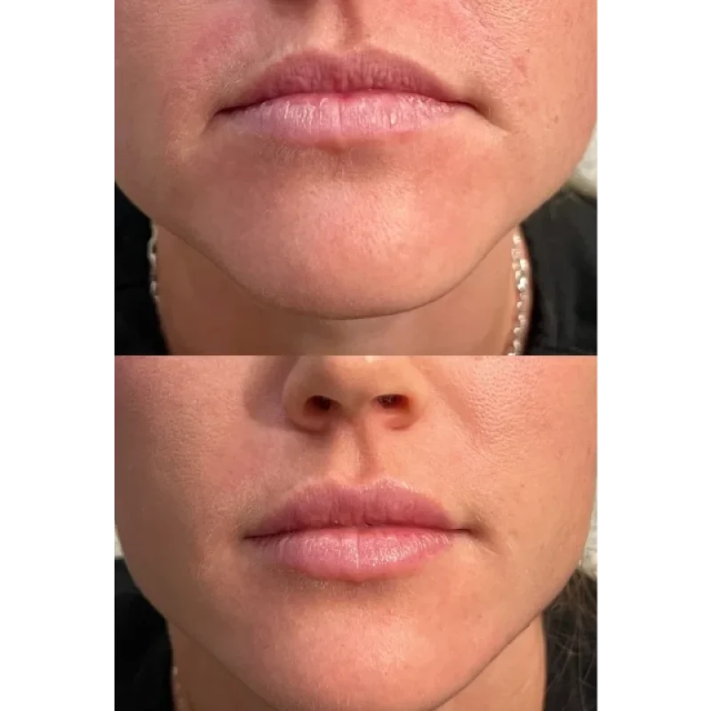 before-after-skinvive-b-juvederm-dermal-filler-collection-in-evans-ga-a-edit