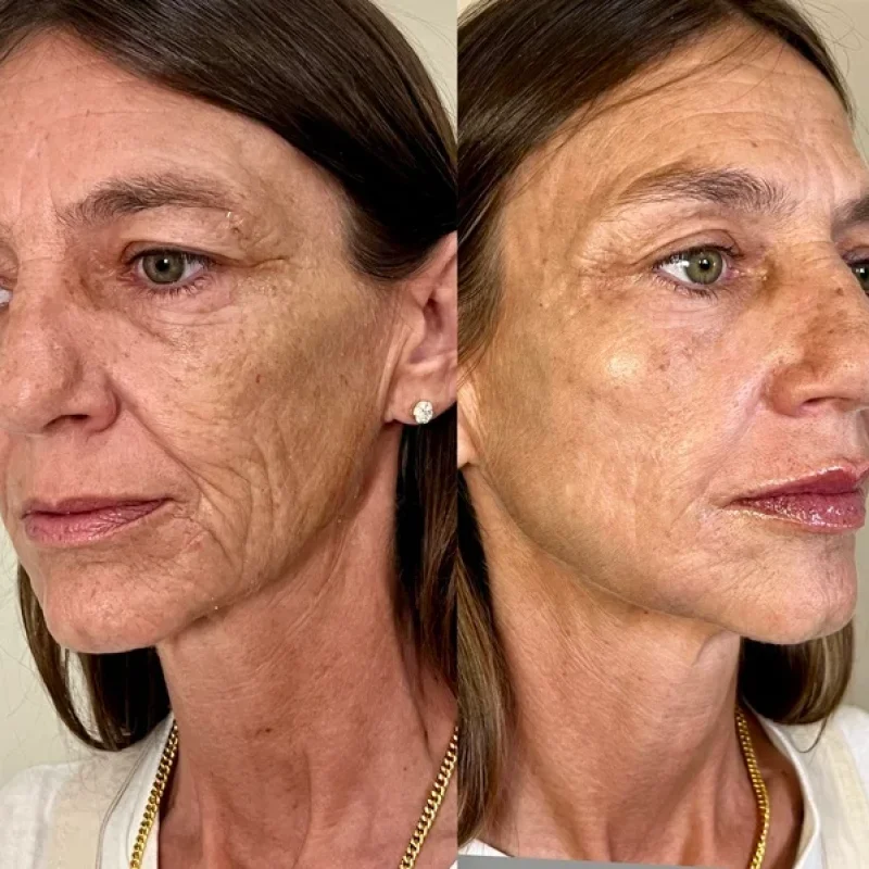 before-after-skinvive-c-juvederm-dermal-filler-collection-in-evans-ga