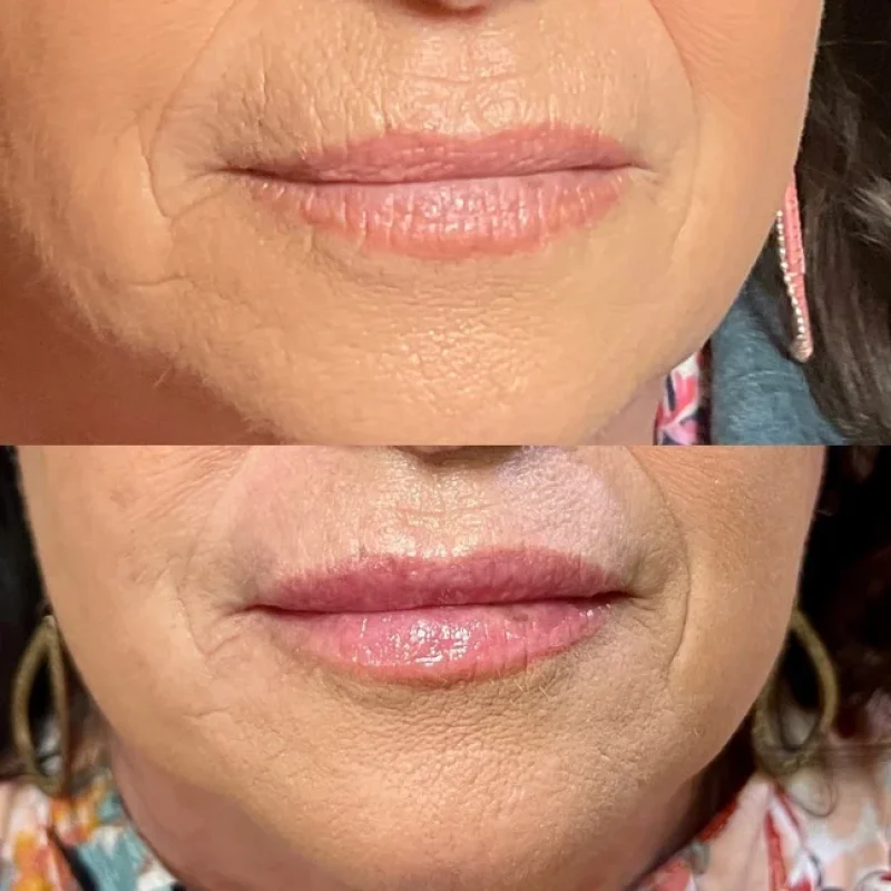 before-after-skinvive-d-juvederm-dermal-filler-collection-in-evans-ga