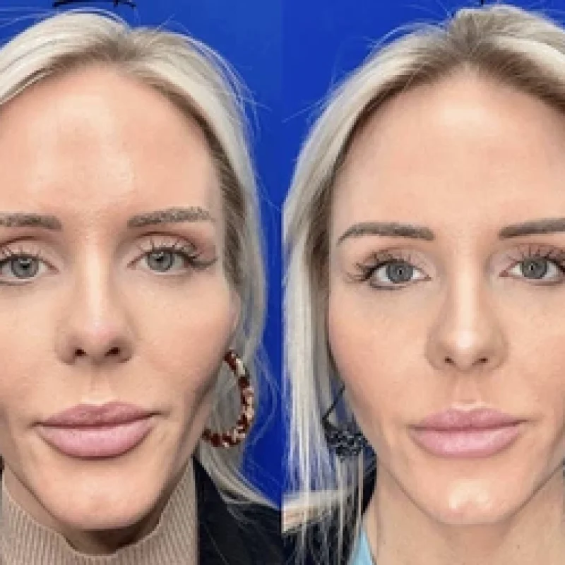 before-after-temple-a-juvederm-dermal-filler-collection-in-evans-ga