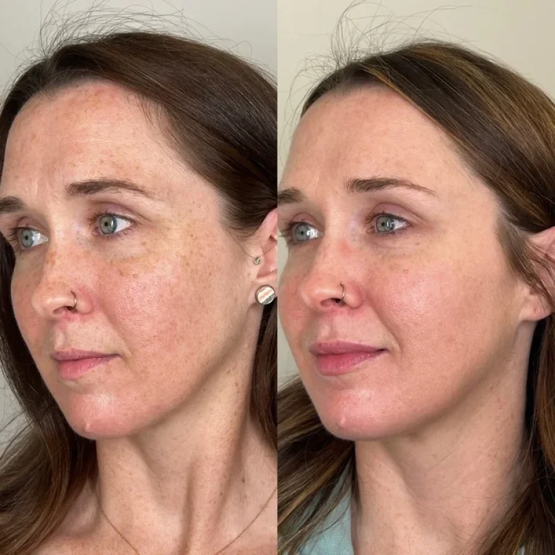 the-vi-chemical-peel-f-collection-in-evans-ga